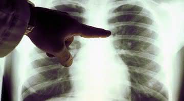 Imagem ilustrativa de radiografia de pulmão - Getty Images